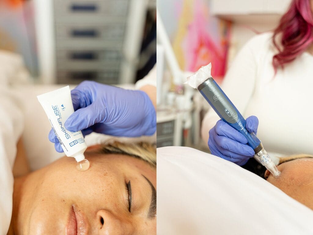 Microneedling session at Virginia skin spa with calm, professional setting